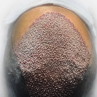 U.K. Hair Transplants - Book a FREE consultation today.