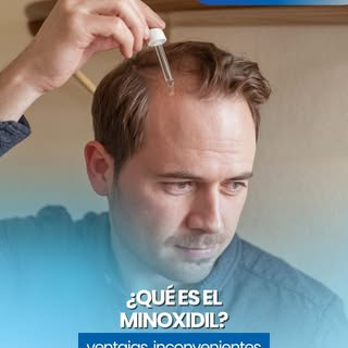 ✨Minoxidil, una solución para la alopecia androgénica en hombres y mujeres✨



La calvicie ya no