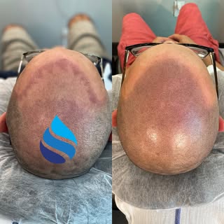 •NATURAL HAIRLINES TO PLEASE•

•SMP ARTISTRY FOR HAIRLOSS•