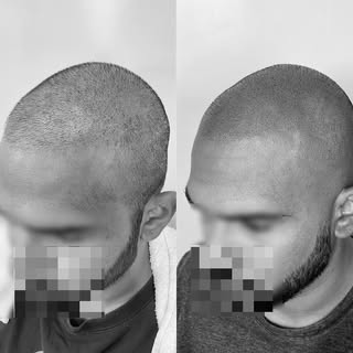 •RESULTS• 
SMP ON A FUE HAIR TRANSPLANT FOR ENHANCEMENT OF DENSITY

•Natural Hairline ☑️
•Smooth Ble