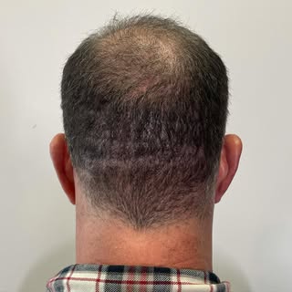 SCALP MICROPIGMENTATION FUT SCAR CAMOUFLAGE 
•
⬅️SWIPE FOR VIDEOS & B4