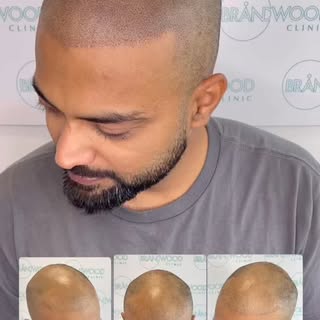 Client Transformation ⭐

After a failed hair transplant left him struggling with his self-esteem and