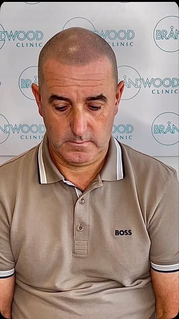 Shane travelled from Nottingham to have his Scalp Micropigmentation treatment at Brandwood Clinic . 