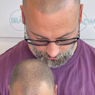 Hairline and thinning crown area successfully reversed with our Award winning  Scalp Micropigmentati