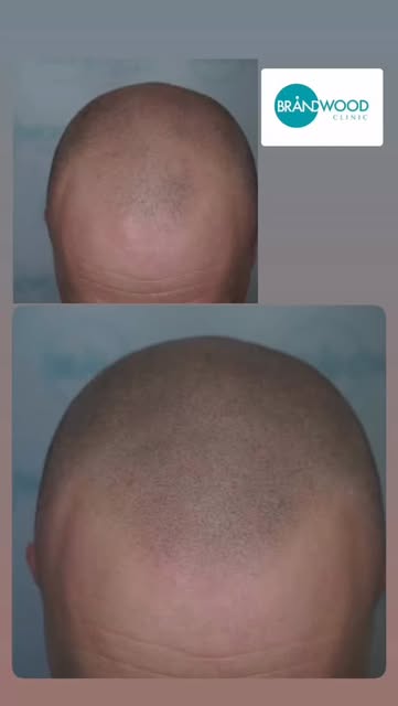 Your Hair loss  journey starts here 
✅15 years smp experience 
✅pioneers of the smp industry 
✅Multi