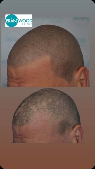 Alopecia doesn’t have to define you. ❤️

Alopecia can have a huge impact on confidence, but Scalp Mi