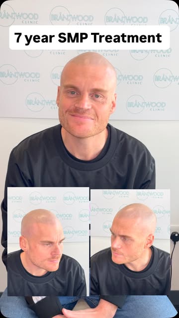 Years On… 👌

Tom had his SMP treatment at Brandwood Clinic with Simon Lane 7 years ago — and just l