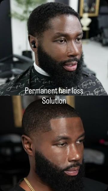 Ladies and gentlemen this is scalp micro pigmentation, the only guaranteed hair loss solution in the