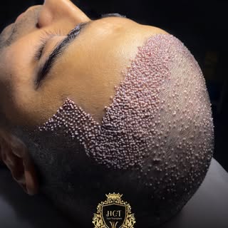 ✨ 4500 Grafts Hybrid Hair Transplant

A carefully planned hair transplant focused on creating a natu