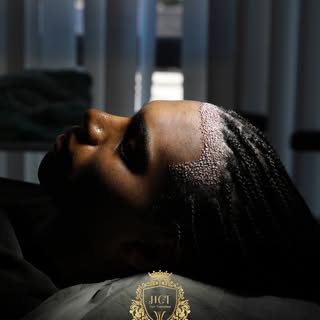 ✨ 2500 Grafts Sapphire FUE Hair Transplant

A carefully planned afro hair transplant performed with 