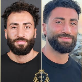 ✨ 8 Months Hair Transplant Result @hamudi_ba_✨

Meet @hamudi_ba_’s incredible transformation after a