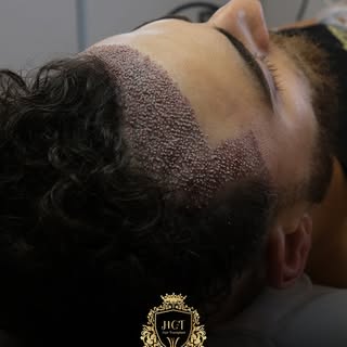 ✨ No-Shave Sapphire FUE Hair Transplant  2750 Grafts

A seamless transformation without shaving the 