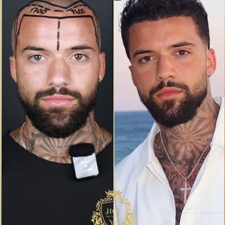 A real transformation. 💯

After 8 months, @georgemorcosofficial hair transplant result shows a full