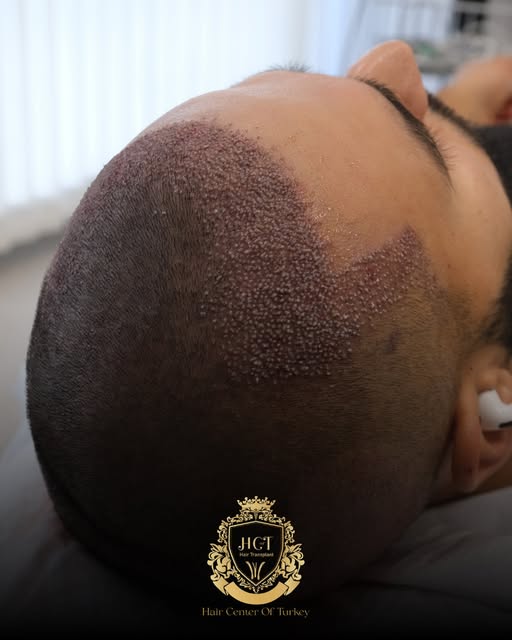 ✨ Natural hair restoration starts with the right planning.

Our guest achieved a fuller, denser, and