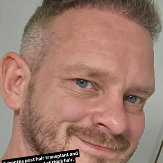 5 months post hair transplant and I have a full head of thick hair already.  Thank you @affirmativeh