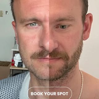 Sapphire FUE hair transplant results from Affirmative Hair Solutions in Turkey 🏳️‍🌈✨

A natural-lo