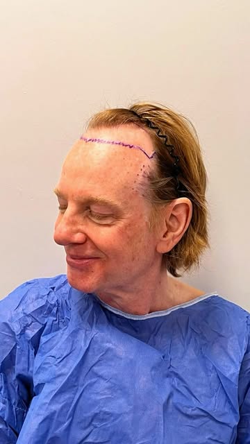 Transgender hair transplant from London to Istanbul 🏳️‍⚧️✈️ 🇬🇧 🇹🇷

For this patient, the goal w