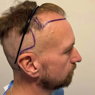 DHI hair transplant results with Affirmative Hair Solutions in Turkey 🏳️‍🌈✨

DHI allows grafts to 