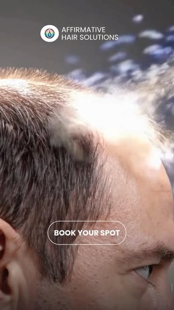 Stem cell therapy combined with a hair transplant 🏳️‍🌈🧬✨

A hair transplant moves healthy follicl