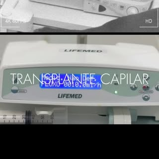 Cada fio transplantado com precisão cirúrgica — técnica, tempo e cuidado que fazem toda a diferença 