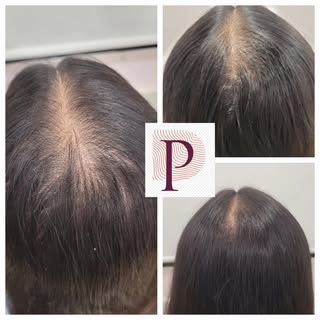 Hair loss isn’t forever.

With GFC Hair Therapy, natural hair regrowth is possible — and you don’t h