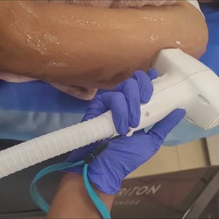 So no to Razor, yes to  laser ! Because it's permanent,has minimal pain, safe and leaves a softer sm