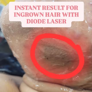 Laser hair reduction offers Ideal and instant solution for Ingrown hair.
#laserhairreduction #ingrow