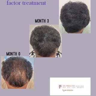 ✨ Real Results: Growth factor treatment + Medical Hair Treatment ✨

💉 GFC: Stimulates dormant folli