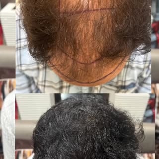 👨‍🦲➡️👨‍🦱 From Grade 6 Baldness to a Head Full of Hair!
💥 33-Year-Old Male | 6780 Grafts | Direc