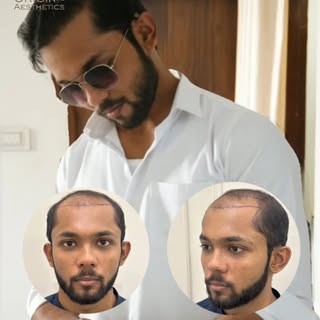 🔥 Think You're Too Young for Hair Loss? Think Again. 🔥
At just 24, he faced Grade 6 Androgenic Alo
