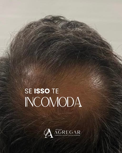 Se a calvície tem feito você se sentir diferente ao se olhar no espelho, talvez esteja na hora de ol