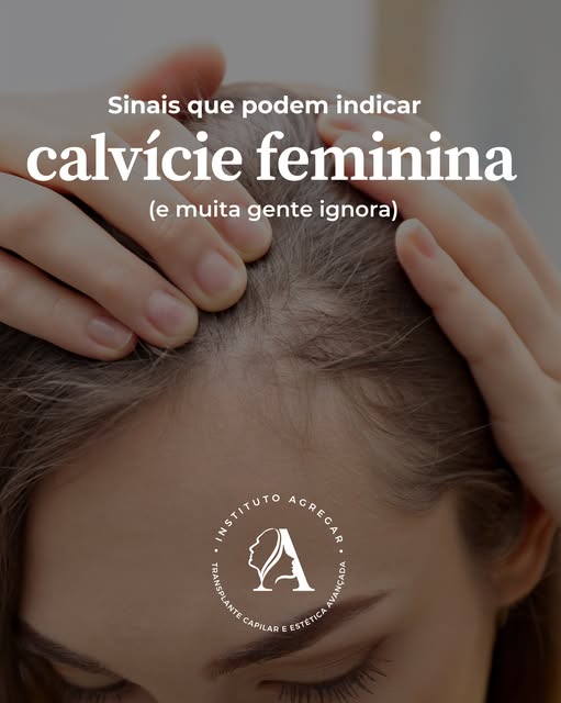 Nem toda queda de cabelo é calvície, mas quando a perda de densidade persiste, é importante investig