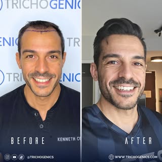 Hair Transplant Before and After Results ✨
The smile says it all, real confidence, real transformati
