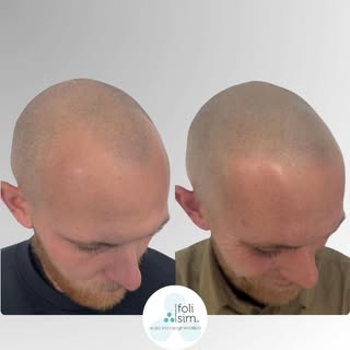 ​The result you want is within reach. This isn't just about 'hair tattoo'—it's about restoring a loo
