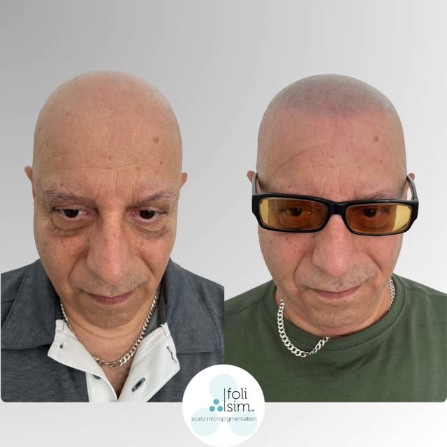 Hairline restoration by Nat in Sydney.

​Whether you are looking to restore a receding hairline, add