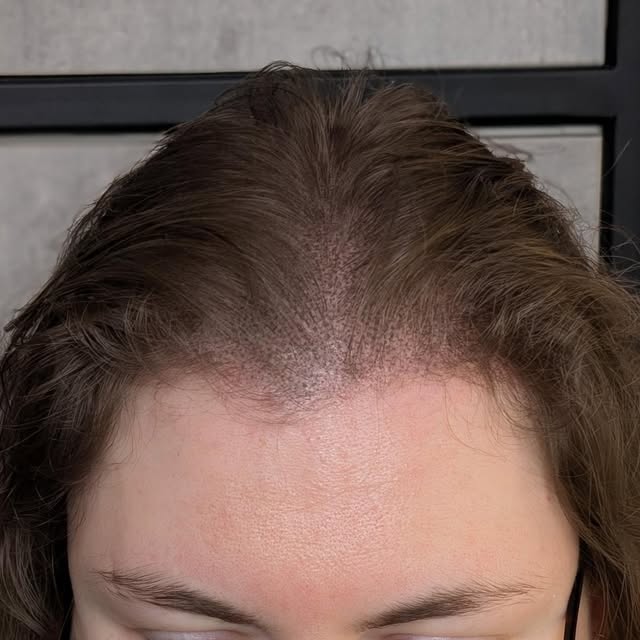 My lovely client has been struggling with Female Pattern Baldness for the past few years, especially
