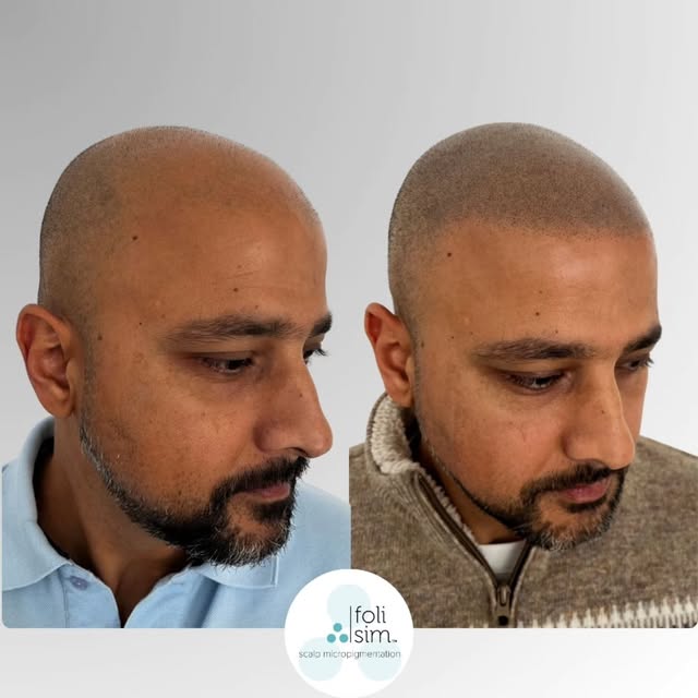 From Sparse to Sharp: A Seamless SMP Transformation by Nat. 

​Check out this incredible scalp micro