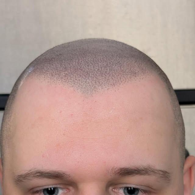 Restore your hairline and get your face shape back again!
This client has a natural widows peak and 