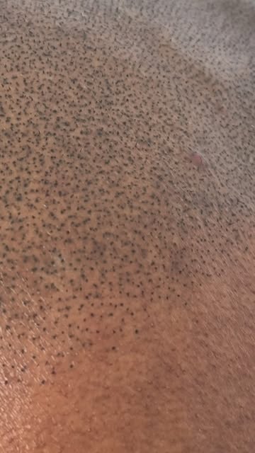 Complete transformation! 

Full head of SMP completed with @folicule done from our @folisim North Me