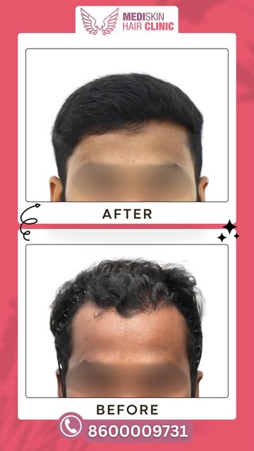 Before vs. After – The Power of Advanced Hair Restoration!

See the difference that “Advanced Hair T