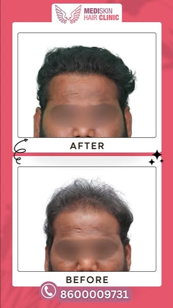 🤔 Wondering if a hair transplant can really make a difference?

Just look at this Before vs. After!