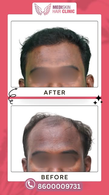 Hair Restoration - Before vs. After Result!

A receding hairline can affect your confidence—but with