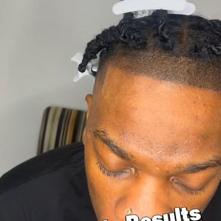 From first session to flawless finish. Watch the full transformation as we bring back what hair loss