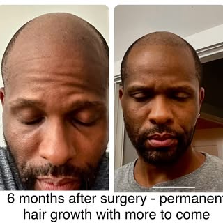 Jerome was an amazing patient who received his hair transplant surgery six months ago. As you can se