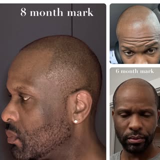 Jerome is at his 8-month mark on his hair restoration journey and he’s still seeing progress. He’s e