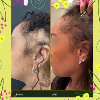 We’re launching our “Edge Control” campaign… take control of your edges …permanently. Hair Transplan