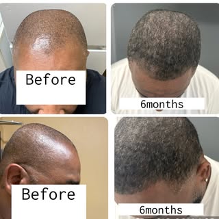 Our patient is at the six month mark with several more months of hair growth and even better results