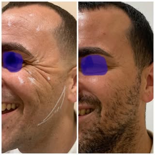 Manejo de arrugas del tercio facial superior, redensificación dermica del tercio medio y marcación d