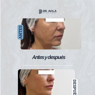Hay resultados que no cambian tu rostro.

Solo hacen que vuelva a parecer el tuyo.

En este caso, el