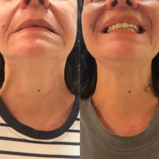 “O botox não rejuvenesce apenas a parte superior do rosto”

Uma das indicações mais interessantes da